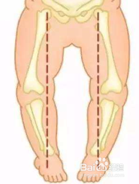怎样预防宝宝o型腿和x型腿