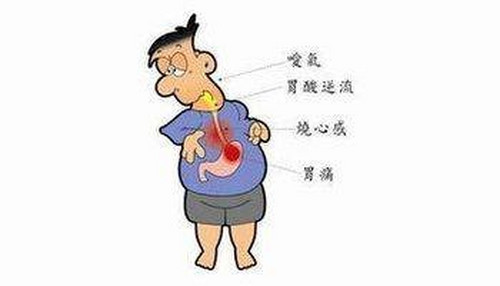 什么是胃食管反流病