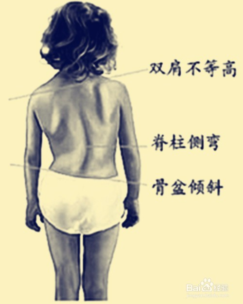 脊柱侧弯锻炼方法