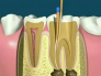 讲解一下牙齿根管治疗