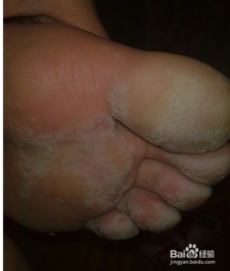 水泡型脚气:趾间,足缘,足底出现米粒大小,深在性水疱,疏散或成群分布