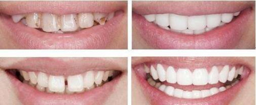 牙齿美白常见的修复方法