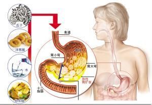 急性胃扩张的三大病因