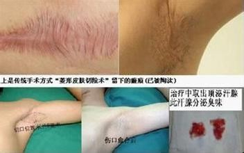 腋臭患者要注意局部清洁,勤洗澡,勤更衣,及时清洗皮肤上的汗腺分泌物