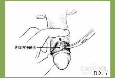 计划隐语 用一把止血钳夹住包皮系带处,以提起包皮.