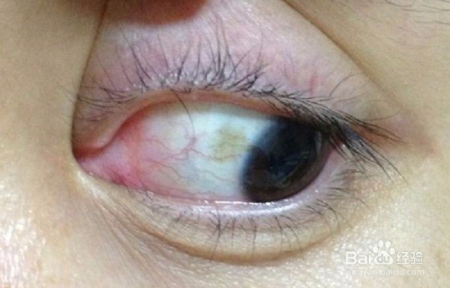 眼睛白眼球有黄斑怎么办,如何预防眼睛黄斑病变