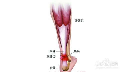 跟腱炎是哪个部位图