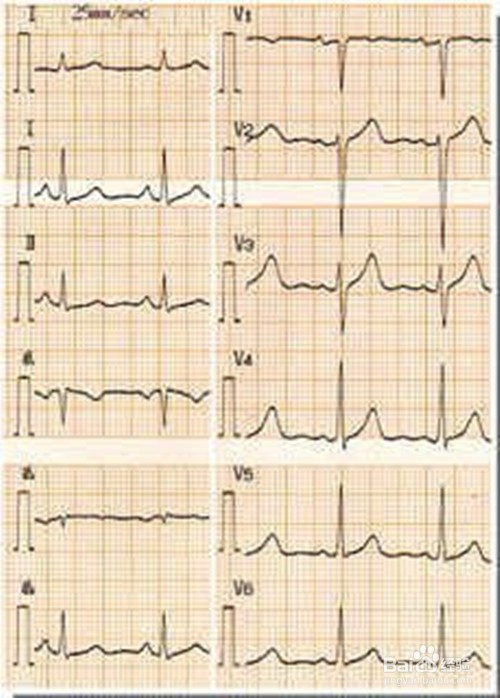心电图怎么看,心电图讲解,心电图t波改变