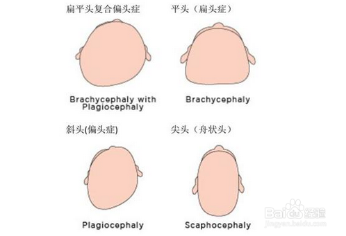 婴儿后脑勺长怎么办