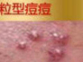 第六个是颗粒型痘痘,一般由丘疹恶化而来,有发炎的症状出现白尖,豌豆