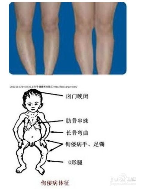 婴儿佝偻病早期症状