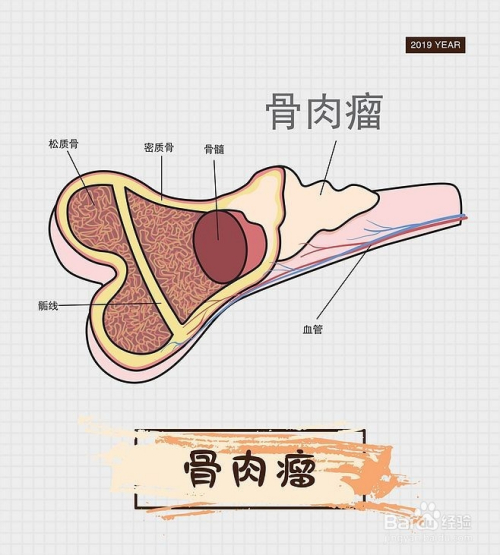 3 骨肉瘤:起源于骨骼的原发性恶性肿瘤,骨肉瘤以青年人为多,好发于