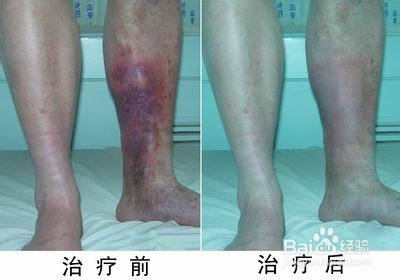 静脉曲张怎么治疗最有效