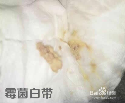 反复霉菌性阴炎的治疗方法及如何避免复发