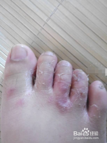 又称足癣,这是由真菌感染引起的,症状除了瘙痒外,脚部,脚趾