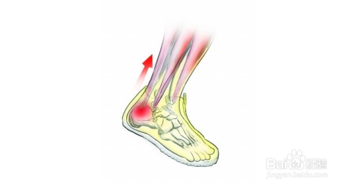 当你行走或是踮脚时,有钝痛或疼痛感.跟腱有触痛和轻度的肿胀.