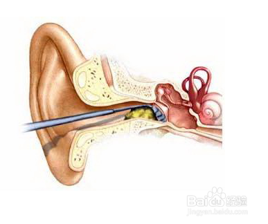 怎么清理耳朵里的耵聍?
