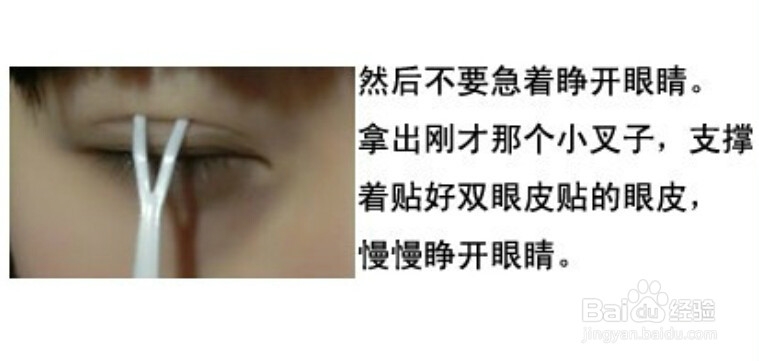 孙桑桑的双眼皮倒贴法