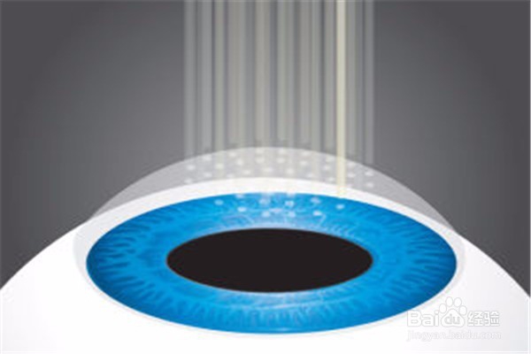 做完近视手术之后怎么恢复的技巧