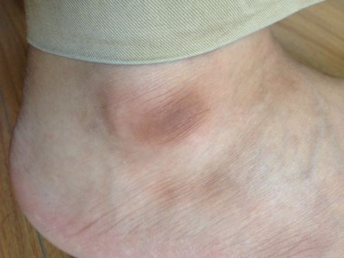 为什么我身上有些地方皮肤很白，有些地方皮肤很黑