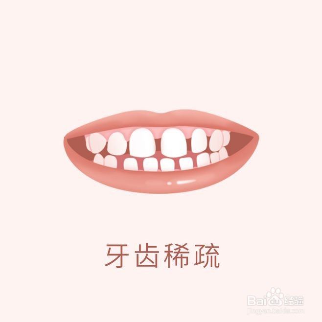 牙齿矫正类型