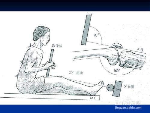 为什么会髌骨软化