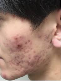 脸上痘痘多怎么办 百度经验