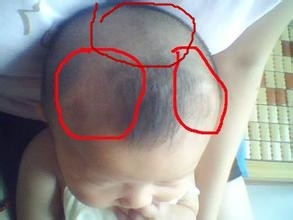 小孩突发高烧怎么办