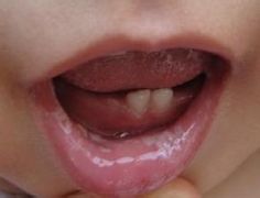 如何判断得了口腔溃疡呢？