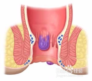 怎样用无花果巧治痔疮