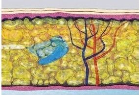 水动力吸脂对比图