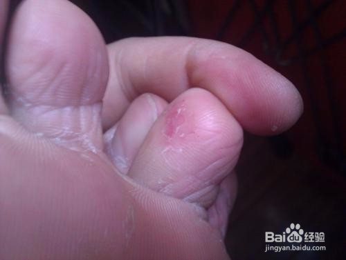 长期有脚气怎么办