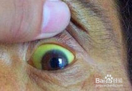 肝硬化的早期症状