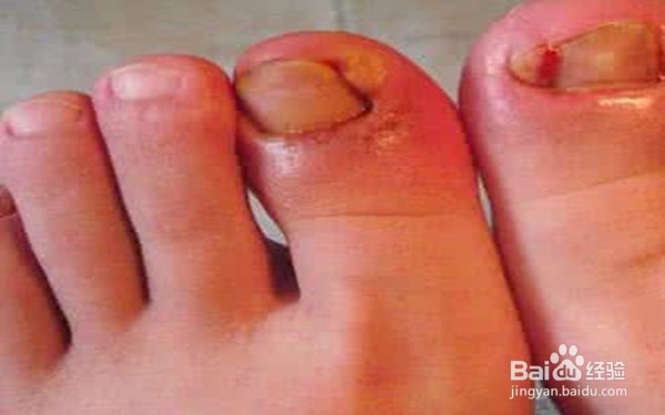 怎样艾灸治疗甲沟炎(灌指边)?