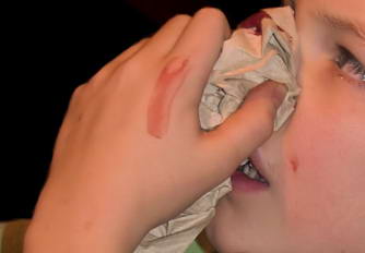 鼻出血的正确急救方法