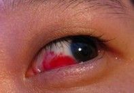 孩子眼睛眼白部分水肿起来了怎么办 百度经验