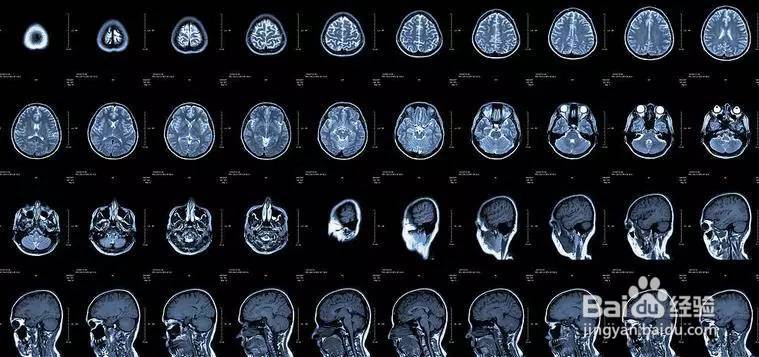 如何识别B超、X线、CT、核磁的共振的不同用途