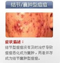 痘痘的种类有哪些