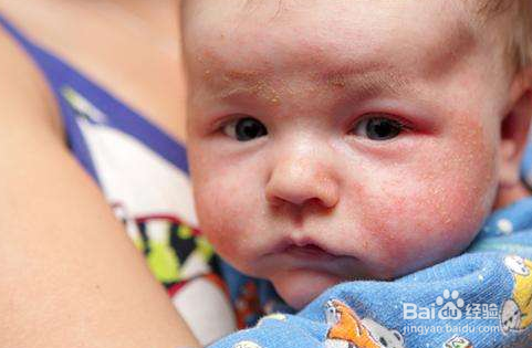 给孩子喂养辅食后孩子出现过敏怎么办？