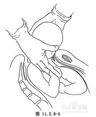 肩难产的七步处理方法