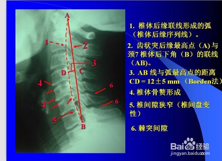 脊椎病的诊断与观片方法
