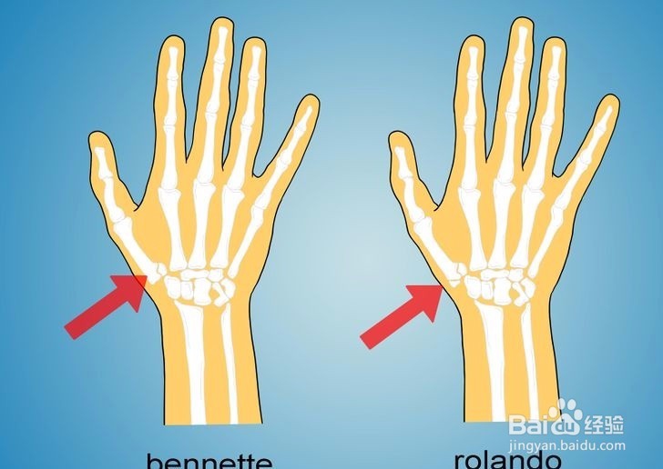 如何诊断拇指是否骨折?