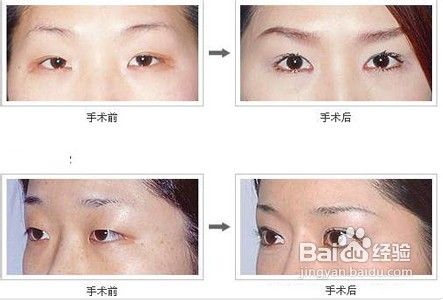 割双眼皮恢复过程图如何呢