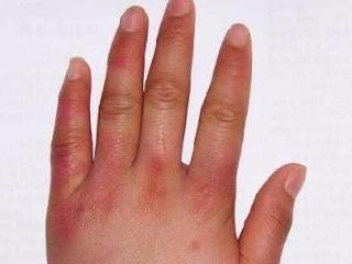 冻疮的药物治疗方法