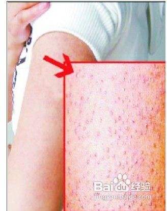 鸡皮肤怎么保养呀(对于鸡皮肤的人皮肤怎么护理) 鸡皮肤怎么保养呀(对于鸡皮肤的人皮肤怎么护理)