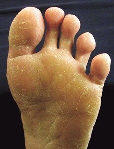 脚气怎么根治最佳