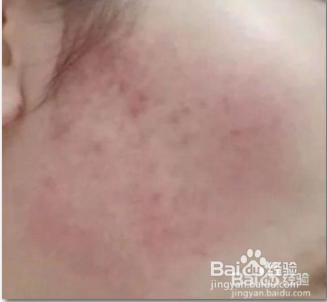 脸上角质层薄怎么办 修复护理方法