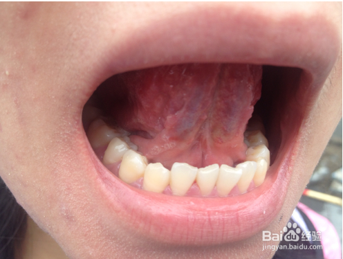 嚼槟榔到底有哪些坏处