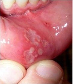 严重口腔溃疡都是有哪些症状?