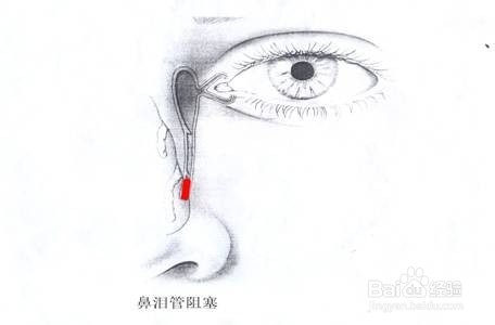 经常流眼泪的原因与治疗